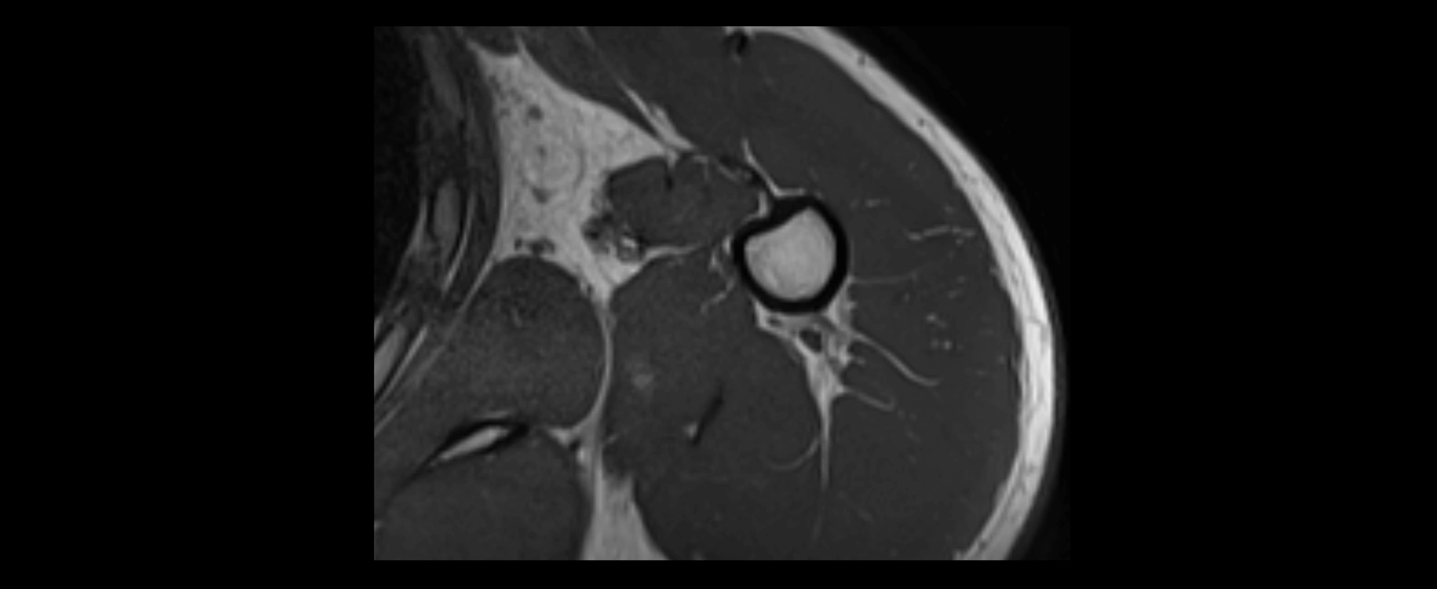 shoulder ligaments axial 3d 3t mri image-img-00005-00111.webp